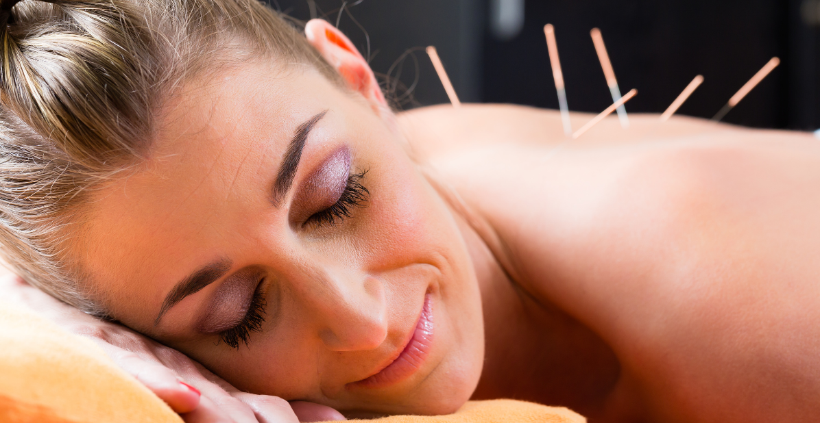 woman getting acupuncture